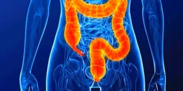 Cáncer De Colon: El Síntoma Temprano Que Muchos Ignoran