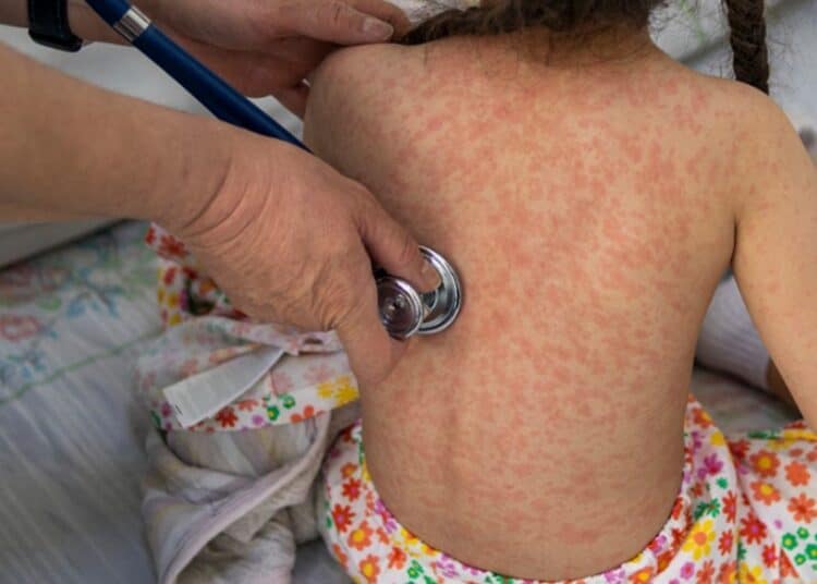 México Registra 9.074 Casos de Sarampión, el Mayor Índice de América